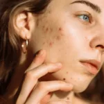 Acne Scars