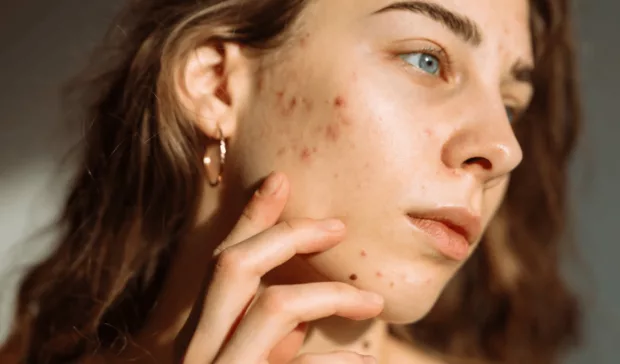 Acne Scars