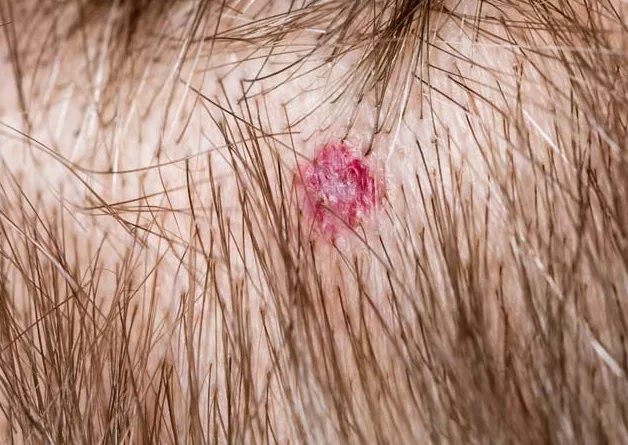 Follisulitis scalp acne