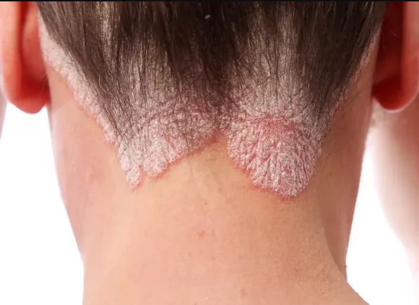 Scalp psoriasis